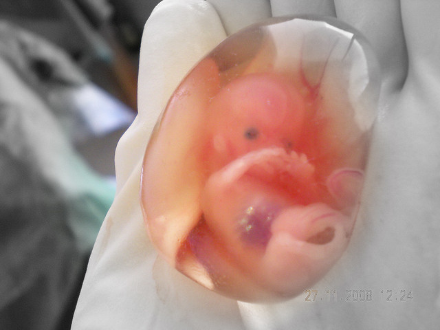 Unborn child
